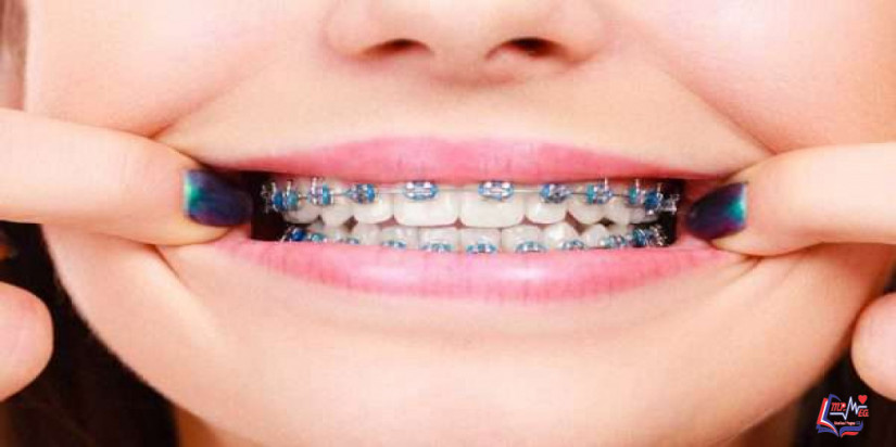 طريقة تركيب تقويم الأسنان