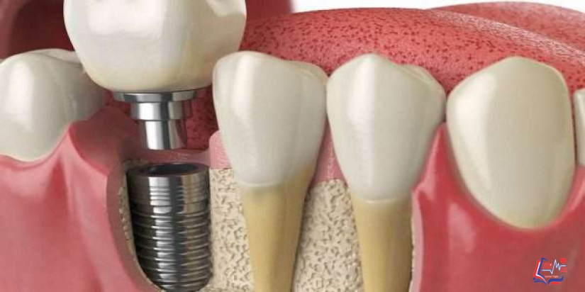 اضرار تركيب الأسنان الثابتة