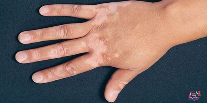 البهاق Vitiligo