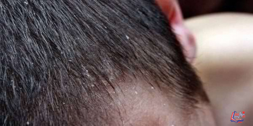 علاج صدفية الشعر بالطرق الطبية المختلفة.. وما أسباب صدفية الشعر؟