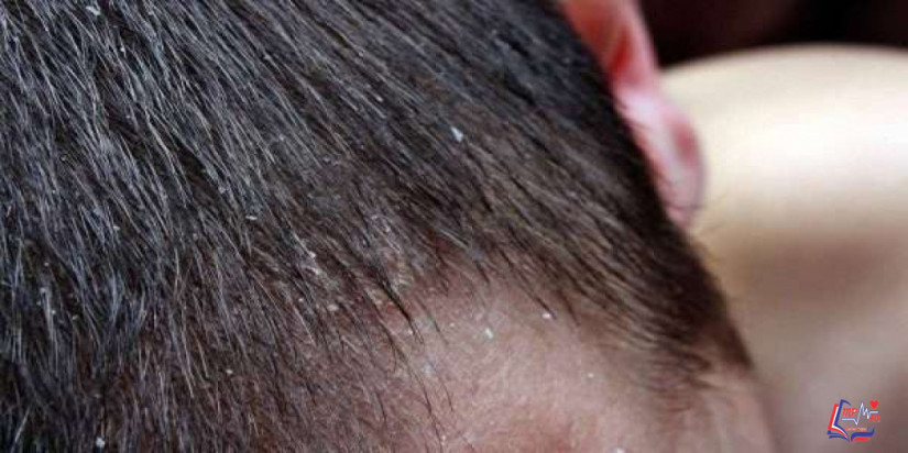 علاج صدفية الشعر بالطرق الطبية المختلفة.. وما أسباب صدفية الشعر؟