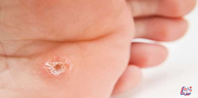 5 طرق لـ علاج عين السمكة وهذه أهم أسبابها!