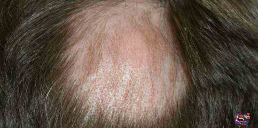 طرق علاج الثعلبة بالأدوية و العلاجات البديلة