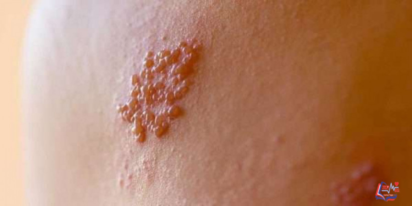 اسباب الحزام الناري وأعراضه وعلاجه