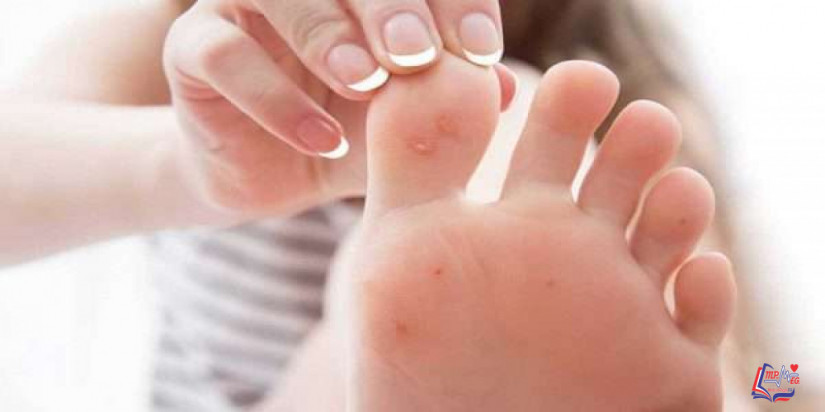 عين السمكة وعلاجها وكل ما يهمك عنها