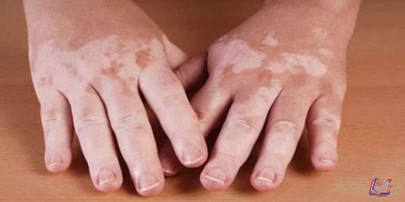 أنواع البهاق