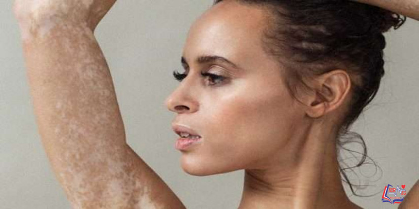 علامات الشفاء من البهاق