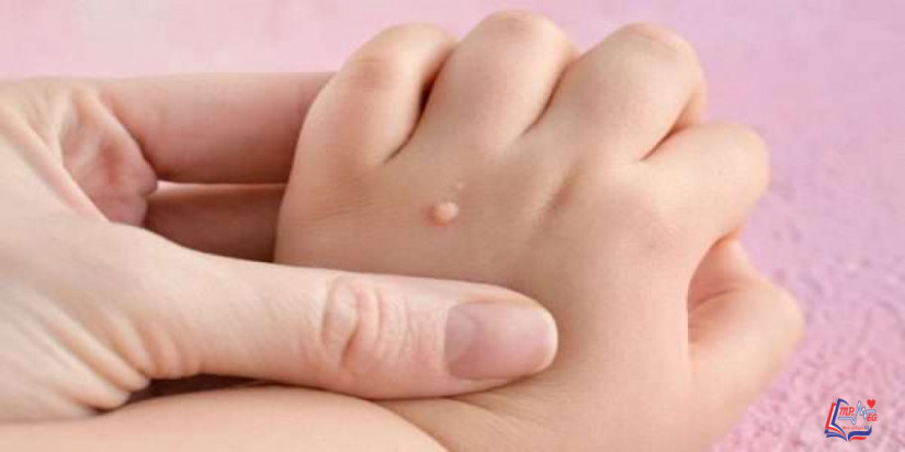 كيفية التخلص من الثؤلول في اليد