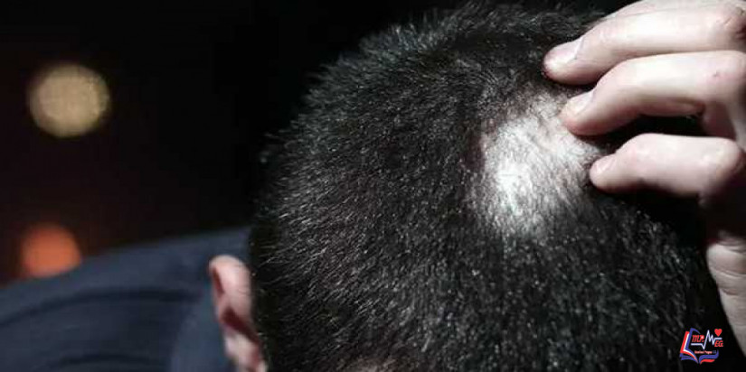 أضرار إبر الكرتزون للثعلبة