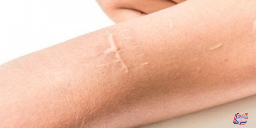 علاج لآثار الجروح