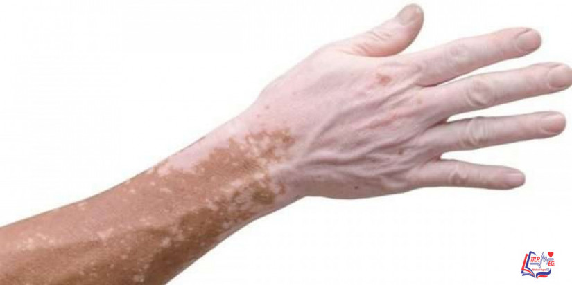 البهاق وفيتامين د