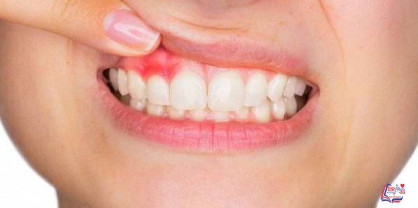 التهاب دواعم السن Periodontitis