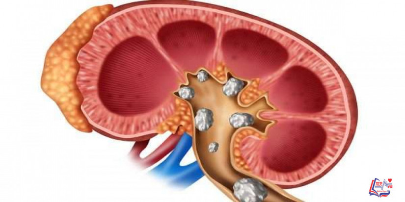 فرط الأوكسالات Hyperoxaluria and oxalosis