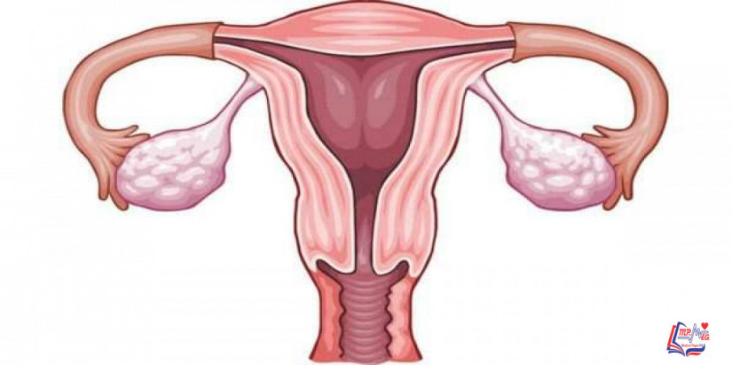 اورام الرحم الحميدة Uterine polyps