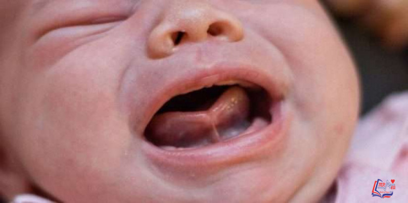 التصاق اللسان Ankyloglossia