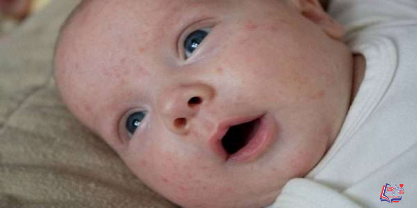 حب الشباب عند الرضع Baby Acne