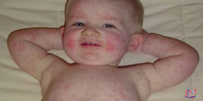 المرض الخامس Fifth disease