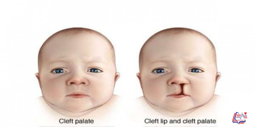 متلازمة دي جورج DiGeorge syndrome