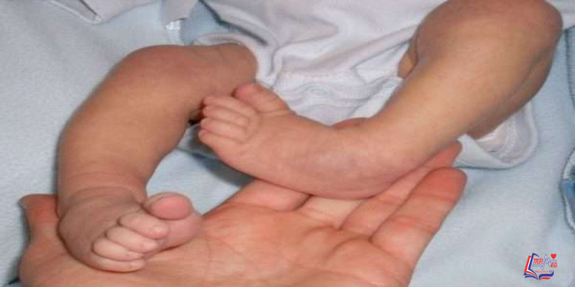 القدم الحنفاء  clubfoot
