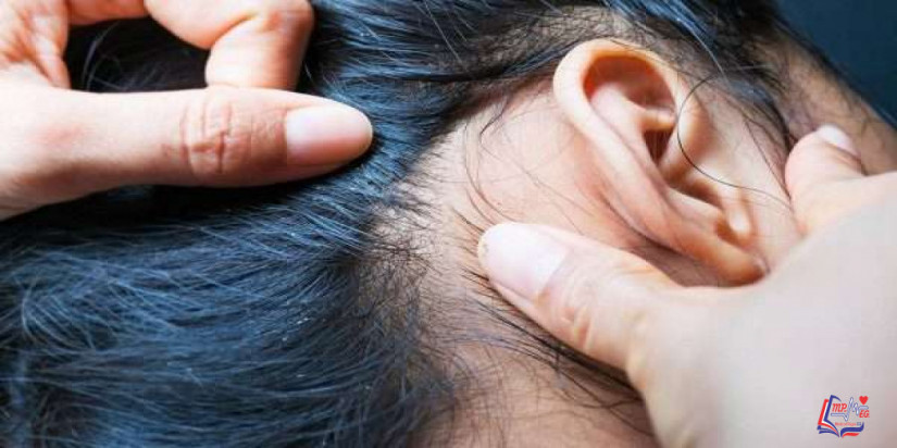 قمل الرأس head lice