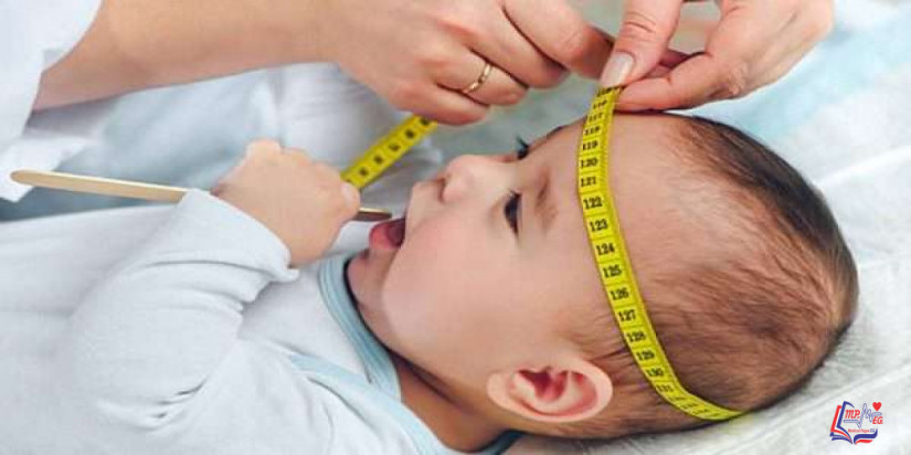صغر الرأس Microcephaly