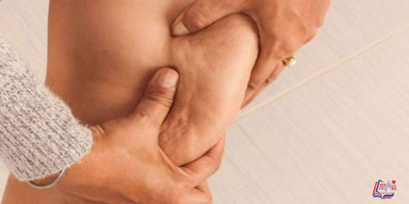 السيلوليت Cellulite