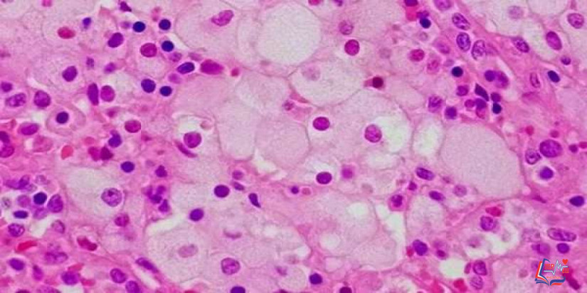 مرض نيمان بيك Niemann-Pick