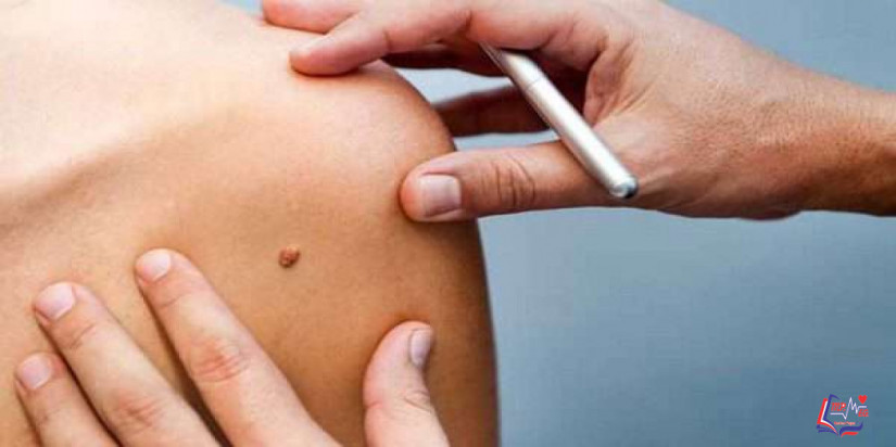 التقرن المثي Seborrheic Keratosis