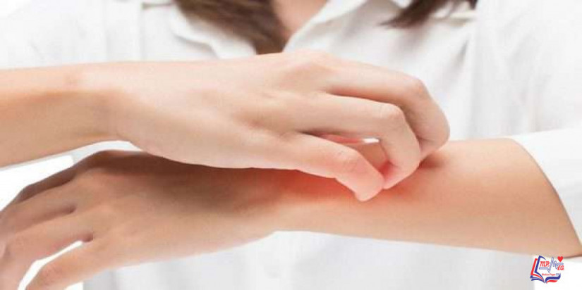 الارتكاريا المزمنة Chronic Hives