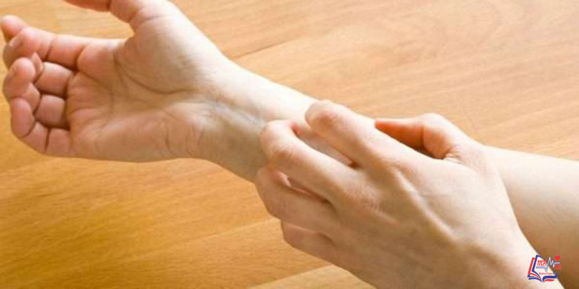 متلازمة سويت Sweets syndrome