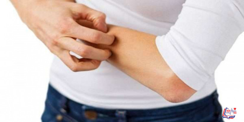 حساسية الشمس Sun allergy