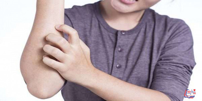 طفح اللبلاب السام Poison ivy rash