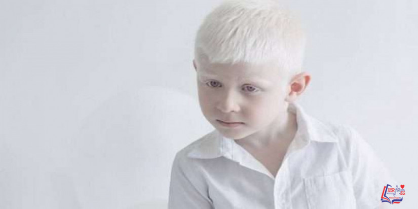 مرض المهق Albinism
