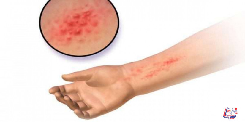 الحساسية ضد اللاتكس Latex allergy