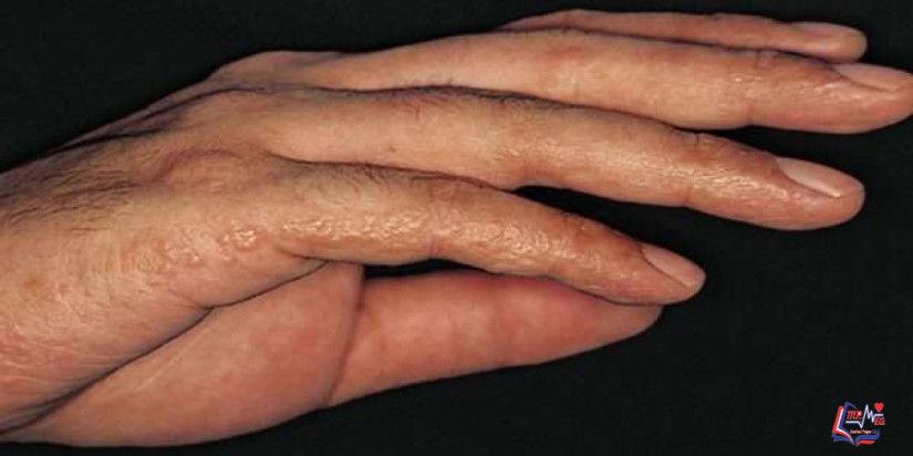 خلل التعرق Dyshidrosis