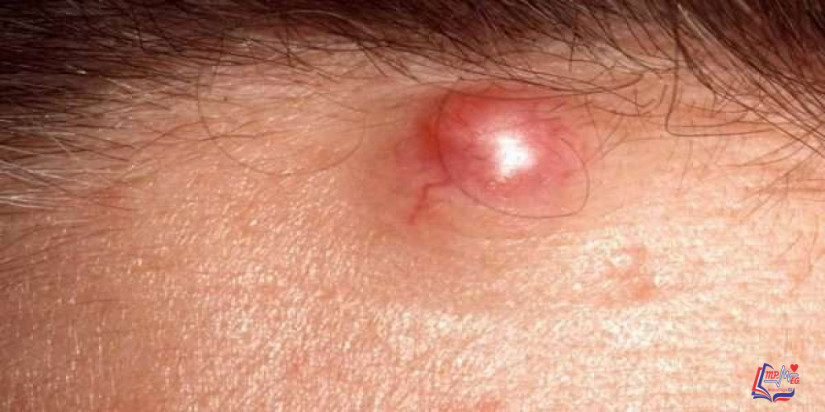 خراج الجلد Epidermoid cysts