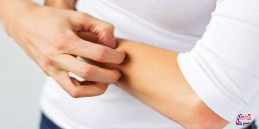 الصدفية Psoriasis