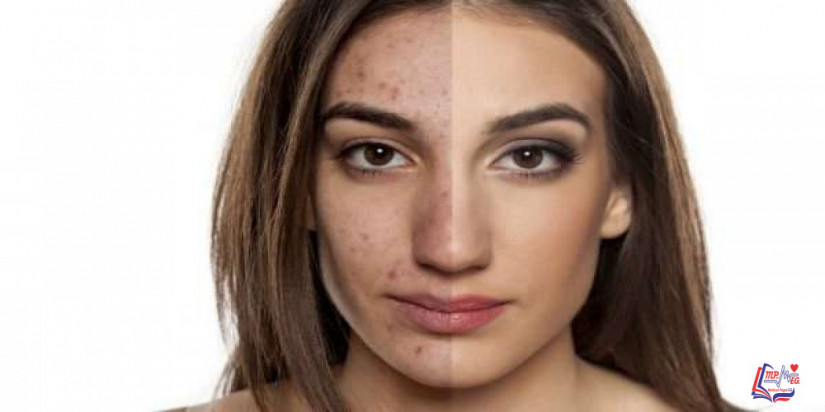 مرض حب الشباب Acne
