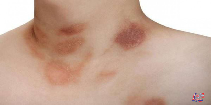 النخالة الوردية Pityriasis rosea
