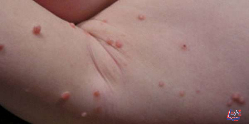 المليساء المعدية Molluscum contagiosum