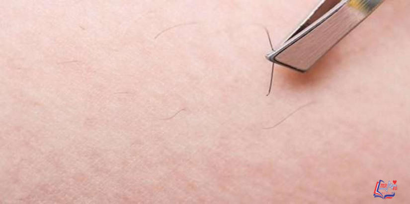 نمو الشعر تحت الجلد Ingrown hair