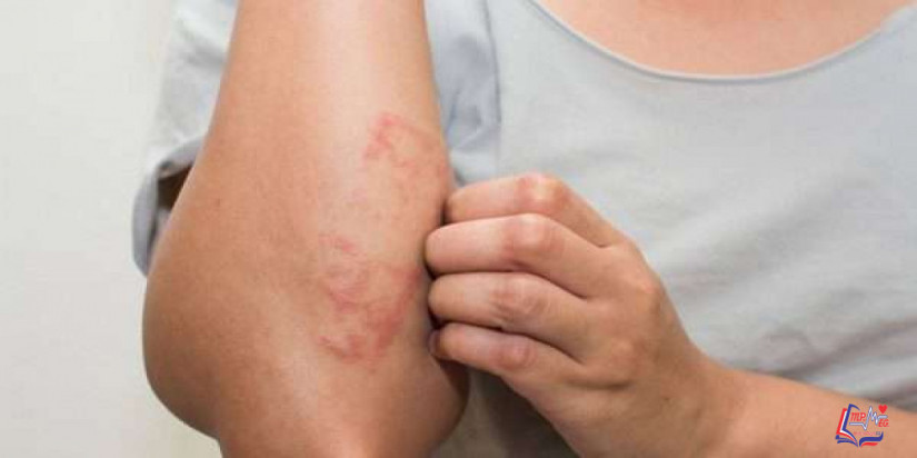 التهاب الجلد التأتبي Atopic dermatitis