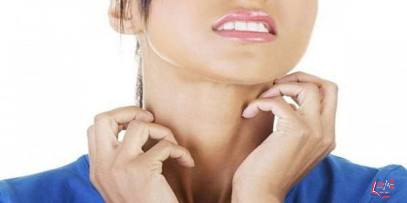 التينيا الملونة Tinea versicolor