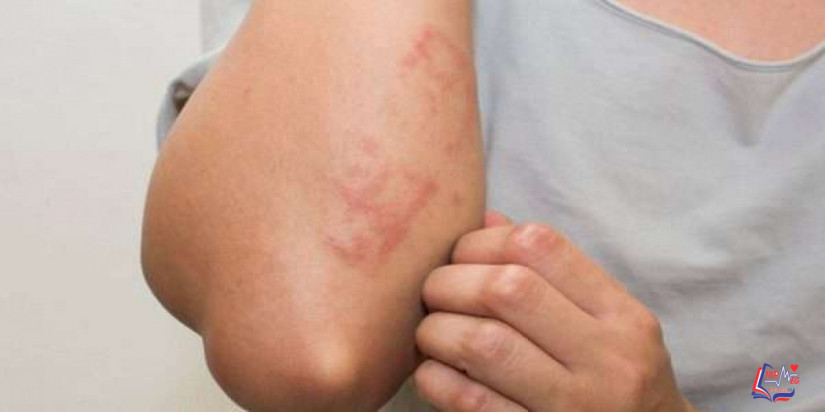 الساركويد Sarcoidosis