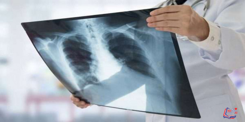 مرض السل Tuberculosis