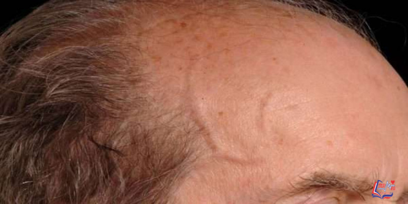 التهاب الشريان ذو الخلايا العملاقة Giant Cell Arteritis