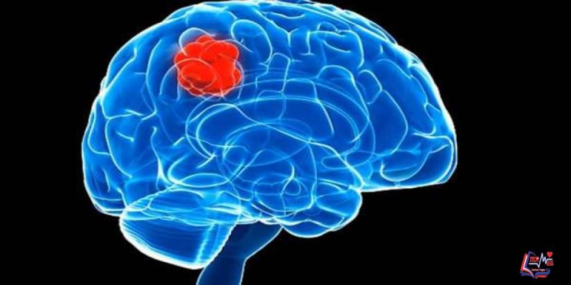 أورام المخ Brain tumors
