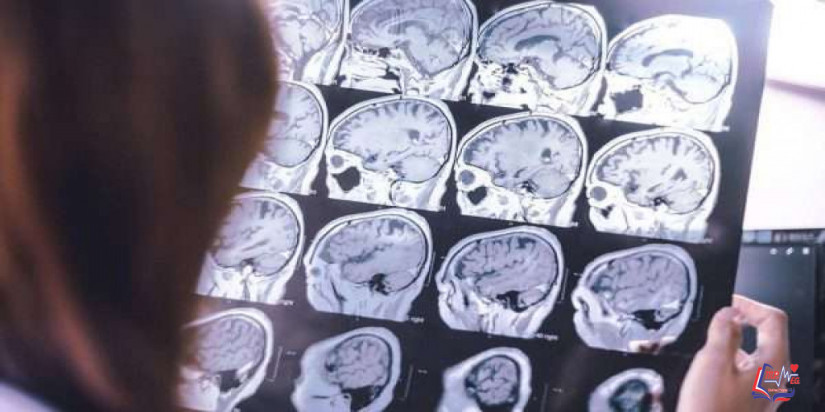 الخرف الجبهي الصدغي Frontotemporal dementia