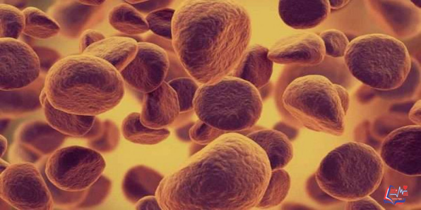 سرطان الدم الليمفاوي الحاد Acute Lymphocytic Leukemia