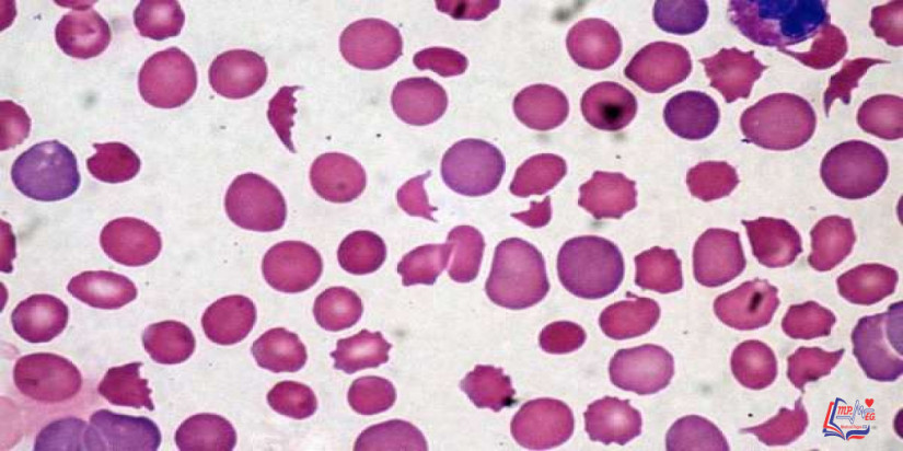 متلازمة انحلال الدم اليوريمي Hemolytic uremic syndrome (HUS)